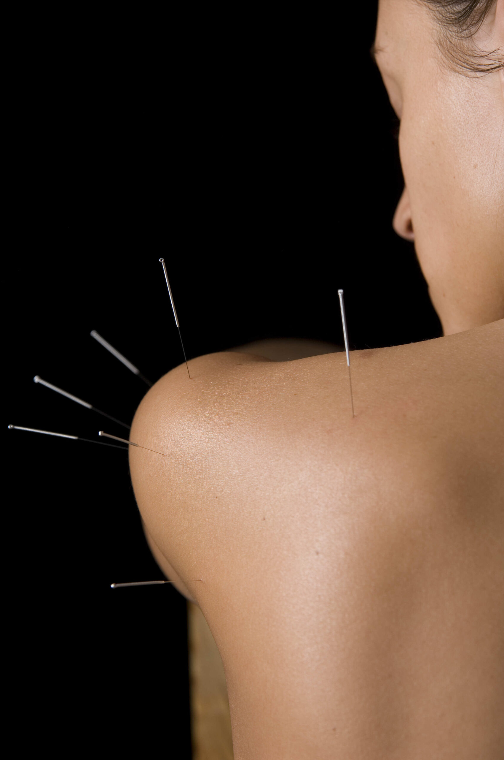 acupuncture treatment needles in shoulder